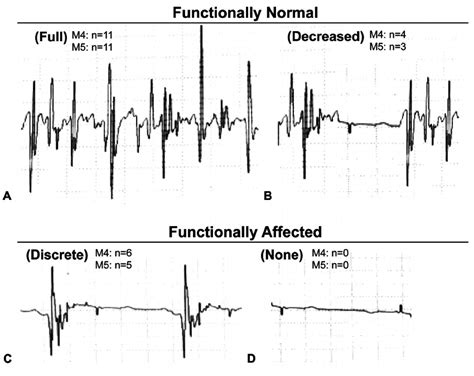 Index TermsElectromyography signal, median frequency, mean frequency, feature extraction, muscle contraction. . What does reduced recruitment mean in emg